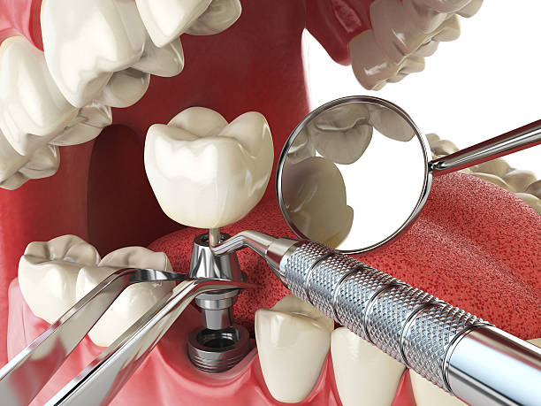 Best Emergency Treatment for Dental Infections or Abscesses in Monroe, UT